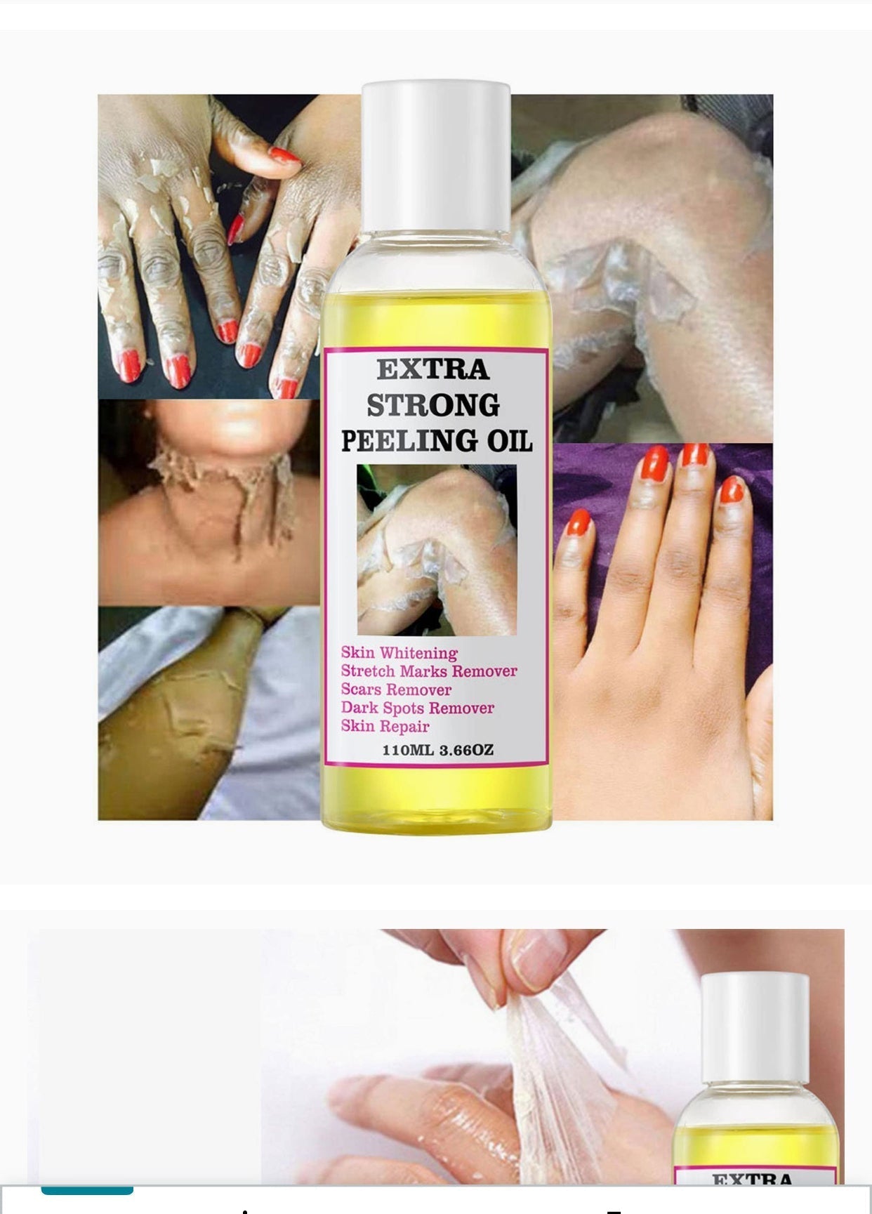 Huile de Peeling Extra forte pour l'élimination des quinto, des vergetures, des hyperpigmentations, et des cicatrices